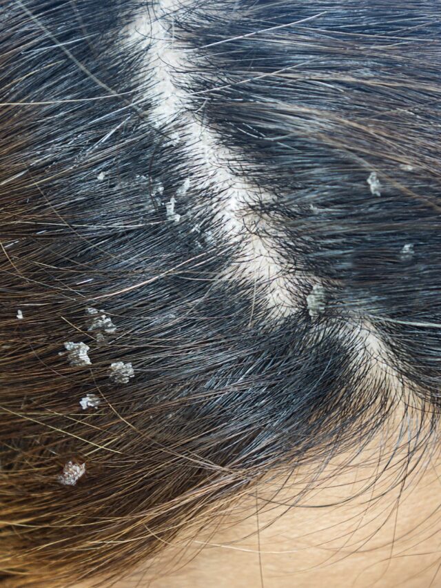 Dandruff cause and treatment